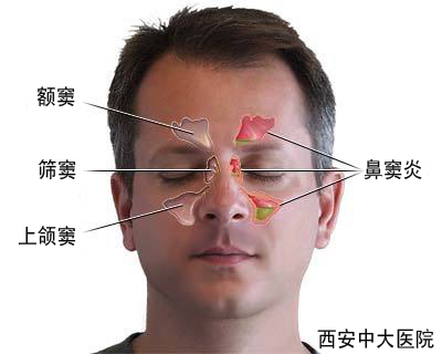 鼻窦炎的症状有哪些